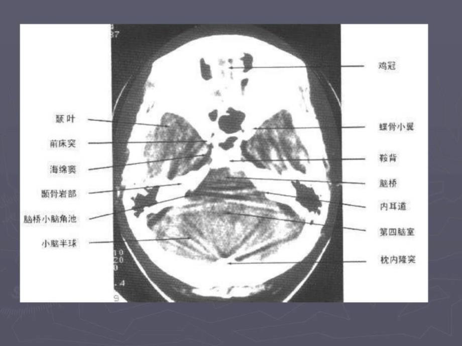 脑出血（cerebralhemorrhage）课件_第2页