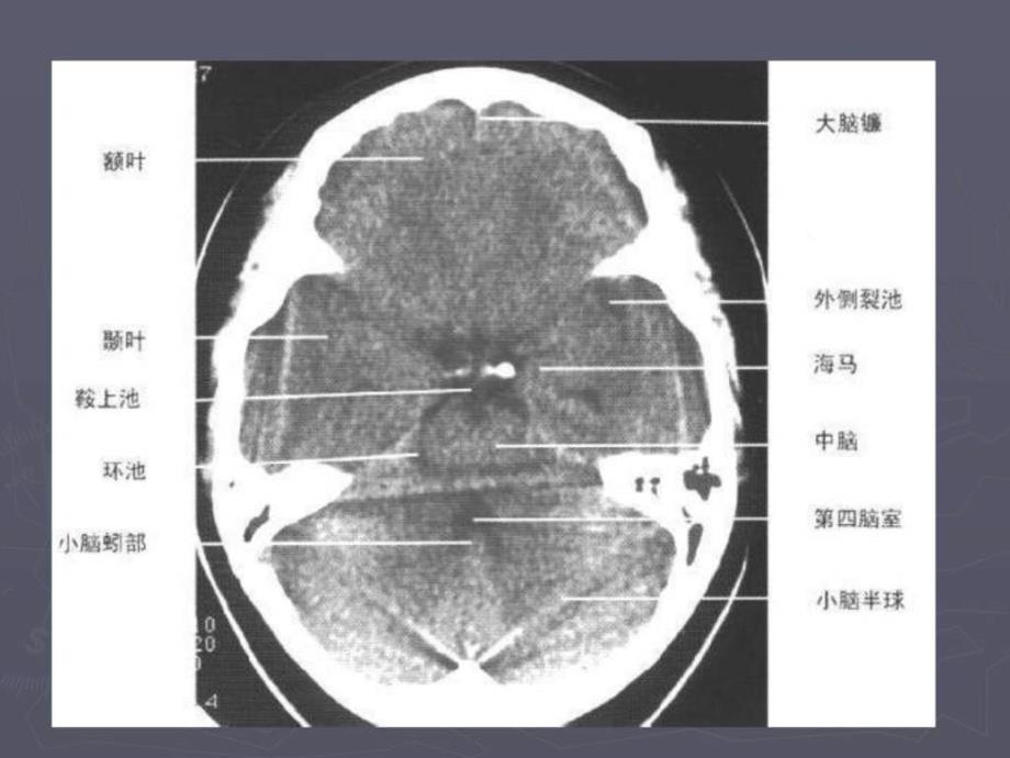 脑出血（cerebralhemorrhage）课件_第3页