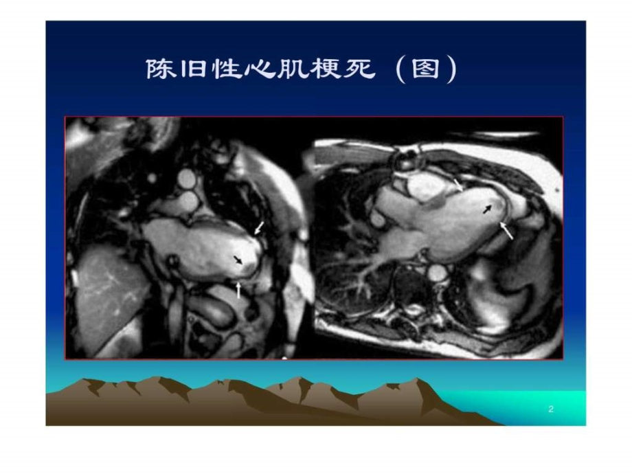 先天性心脏大血管位置和连接异常赵凤祥ppt课件_第2页