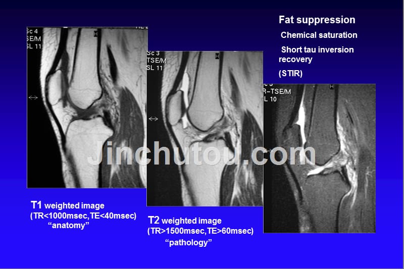 积水潭膝关节mri_第4页