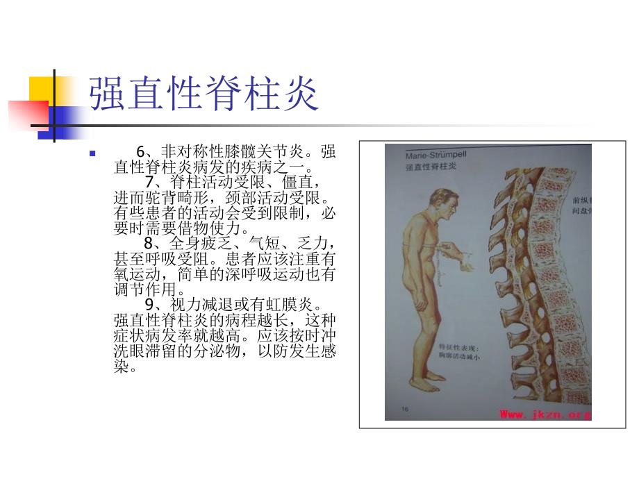 从哪些症状来判断强直性脊柱炎_第3页