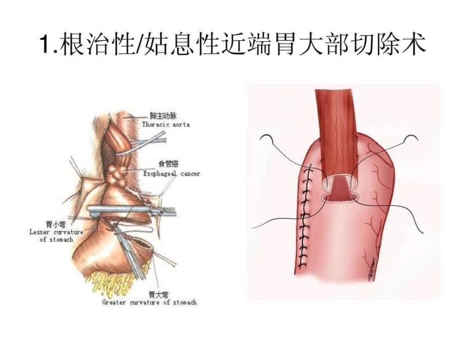 胃癌常见手术方式_1ppt课件_第5页