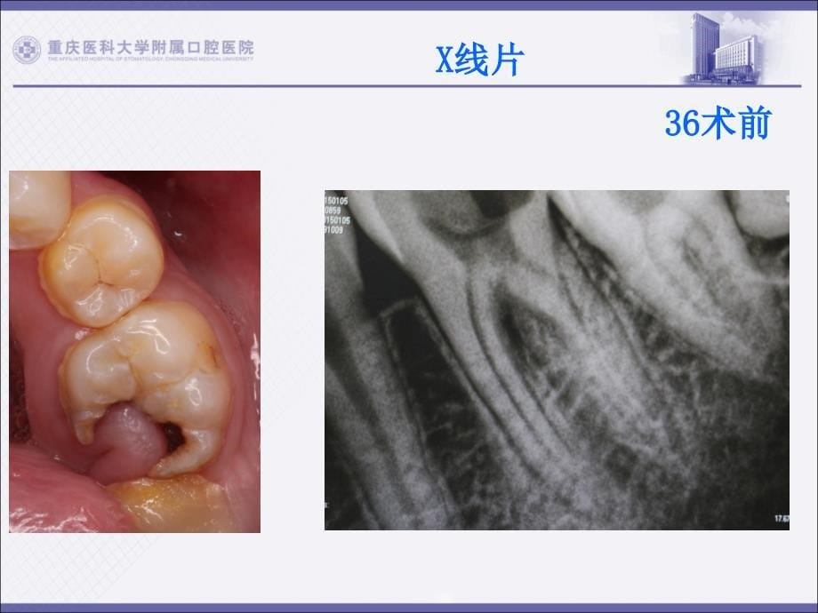 2015年5月牙体牙髓病例_第5页