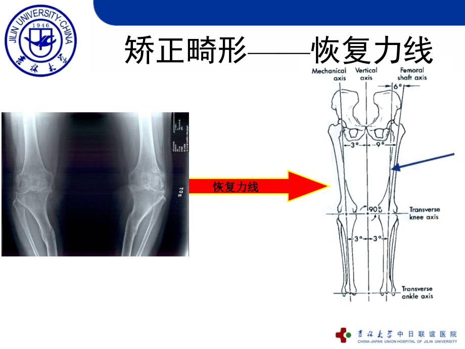 爱爱医资源-膝关节置换的截骨原则ppt课件_第4页