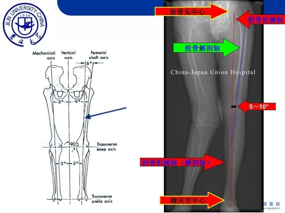爱爱医资源-膝关节置换的截骨原则ppt课件_第5页