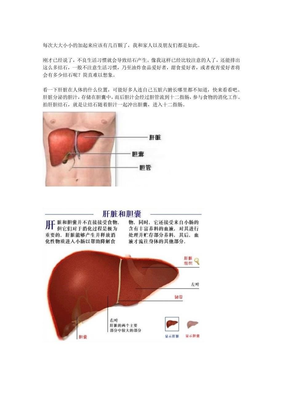 排除肝胆结石方法_第5页