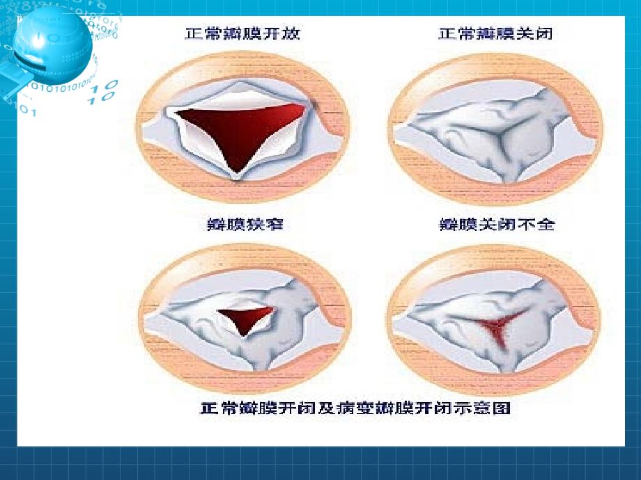 风湿性心脏瓣膜病病人的护理最后版本课件_第4页