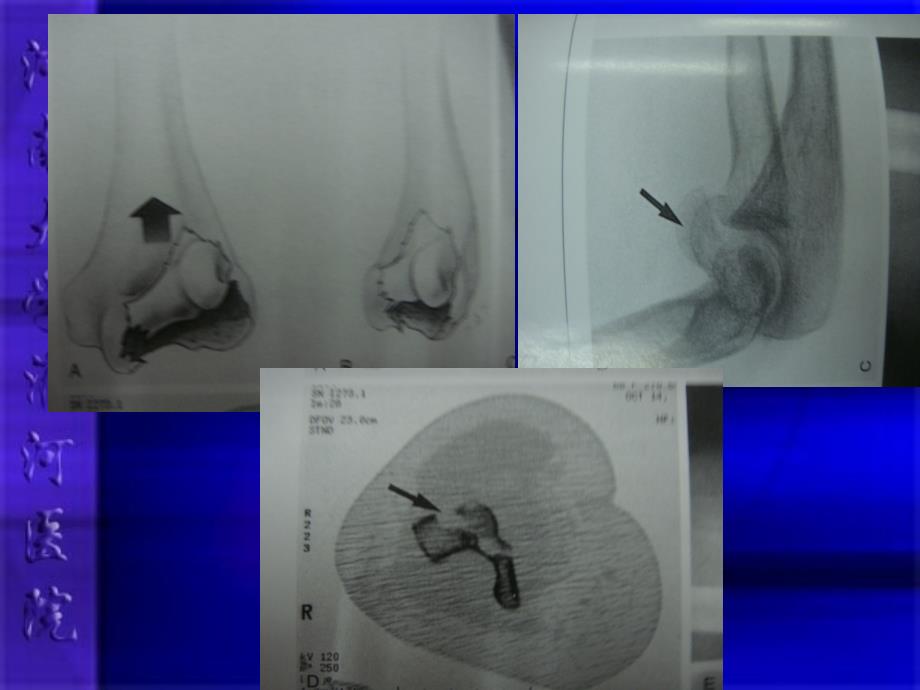 医学肱骨冠状剪切骨折_第4页