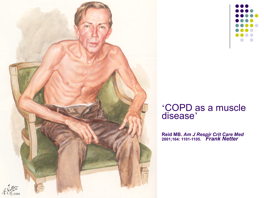 慢性阻塞性肺疾病课件_第4页