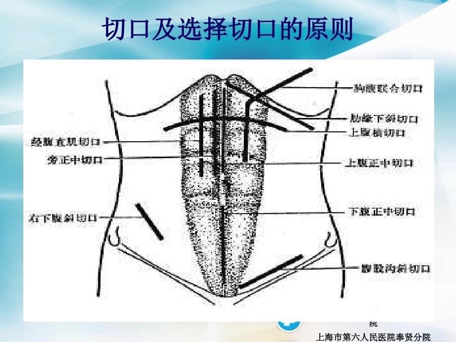 腹部切口选择课件_第5页