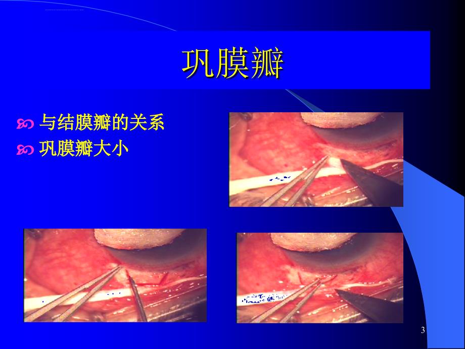 复合式青光眼滤过手术课件_第3页