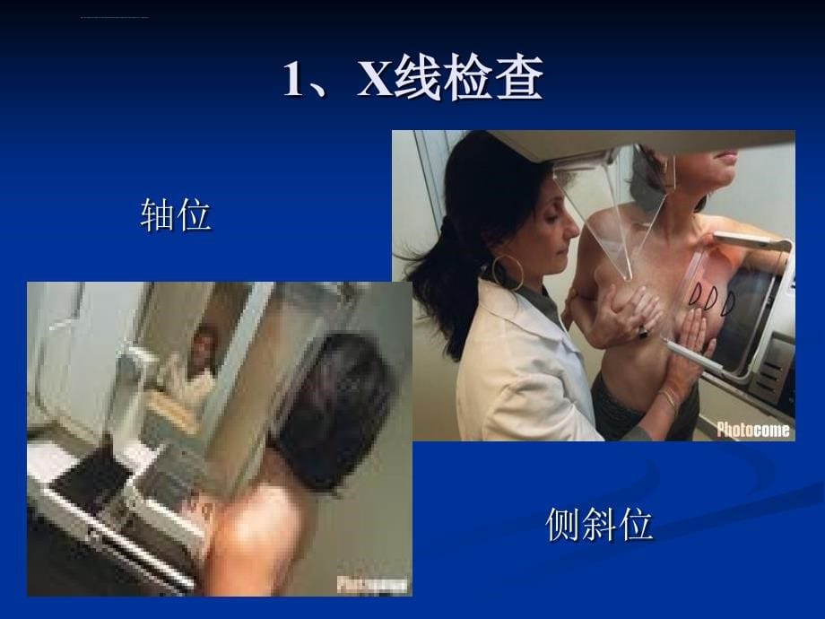 乳腺x线精品图片诊断课件_第5页