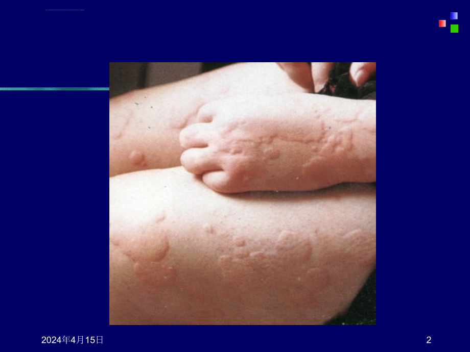 荨麻疹201011课件_第2页