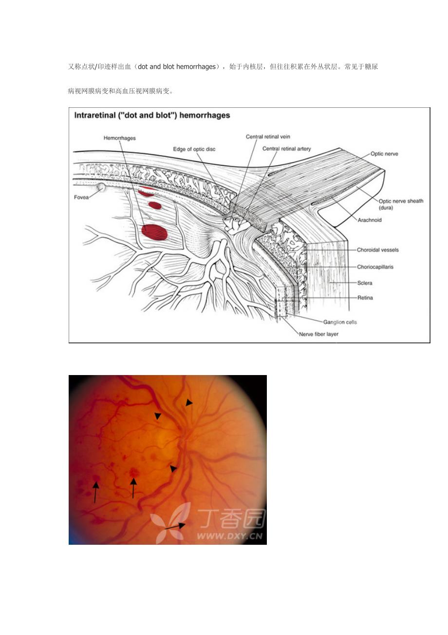视网膜各层出血_第3页