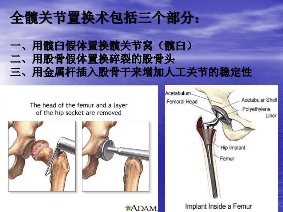 全髋关节置换教学查房课件_第5页