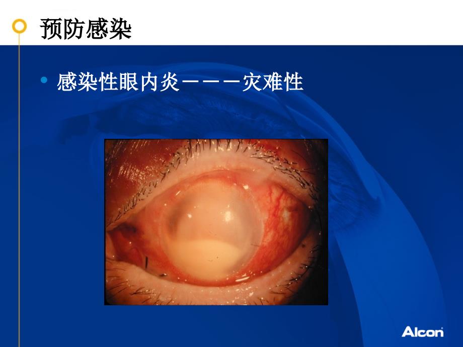 白内障手术围手术期的合理用药课件_第4页