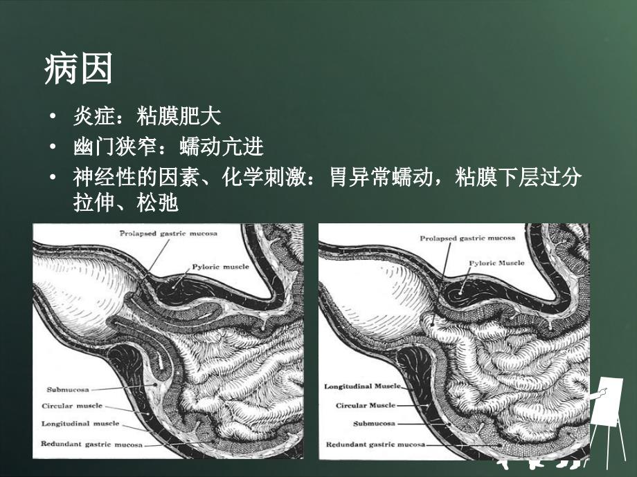 胃粘膜脱垂-姜原_第2页