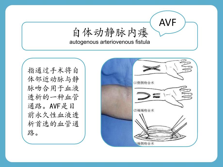 一例使用avf血液透析患者的护理查房课件_第3页