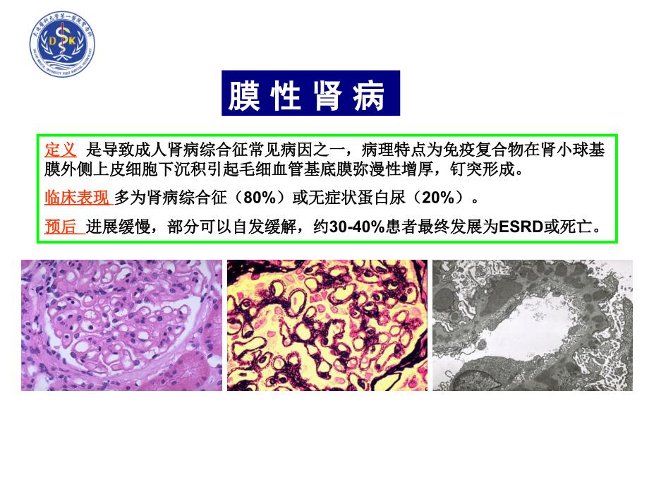 指南解读膜性肾病治疗课件_第2页