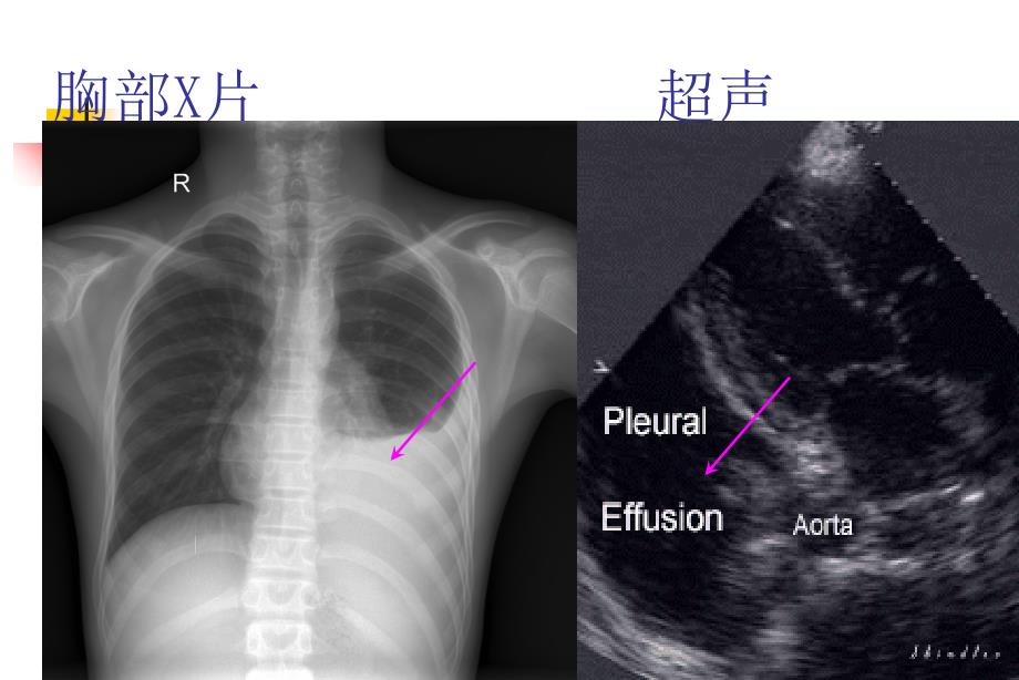 临床技能实验室胸膜腔穿刺术课件_第3页