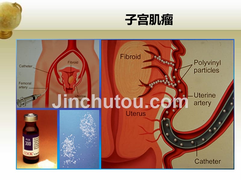 培训资料妇产科介入课件_第4页