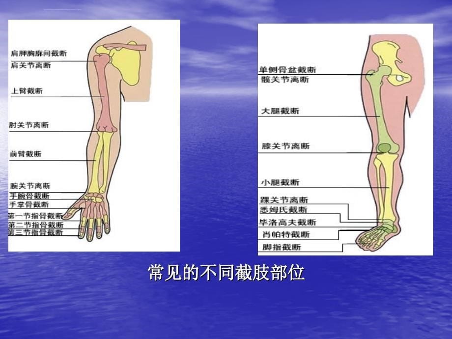 下肢截肢病人护理查房康复科课件_第5页