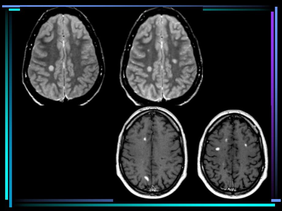 多发性硬化影像诊断简版课件_第4页