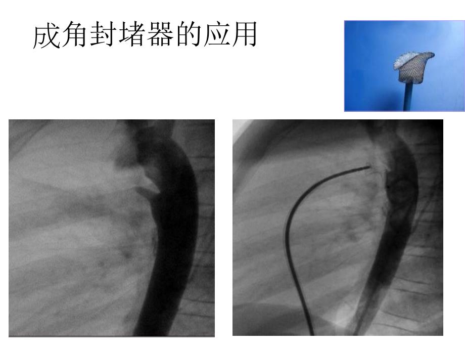 结构性心脏病介入治疗进展c_第4页