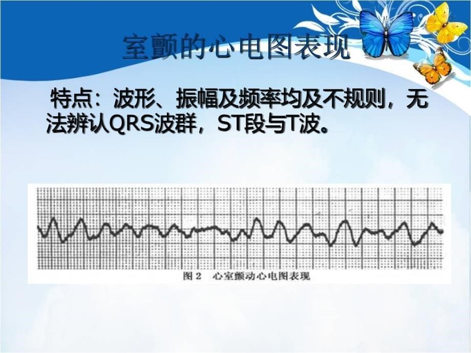 心室颤动的处理预案_第5页