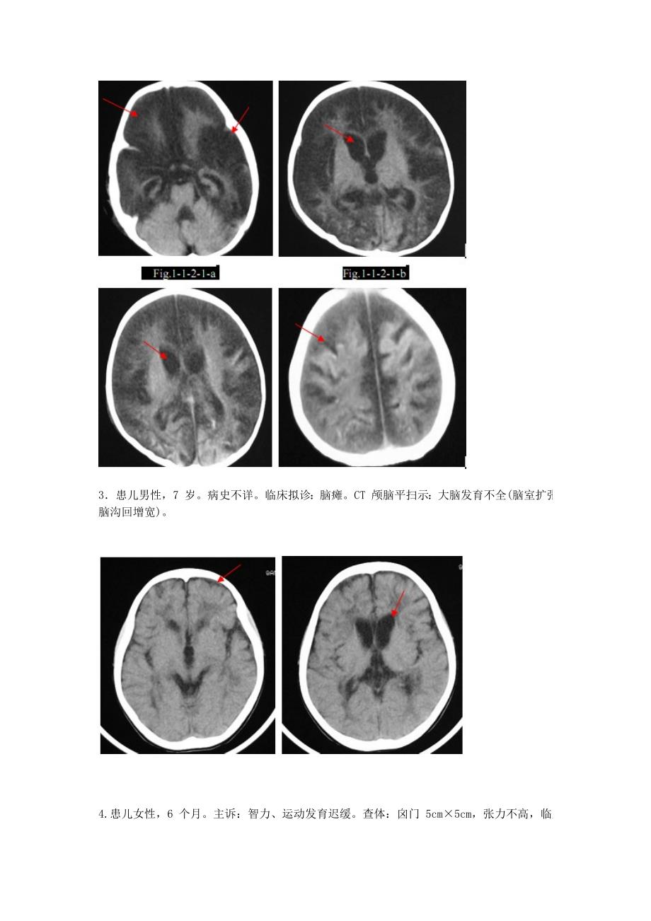 颅脑正常变异与先天异常ct图像(来源于ct临床诊断案例)_第2页