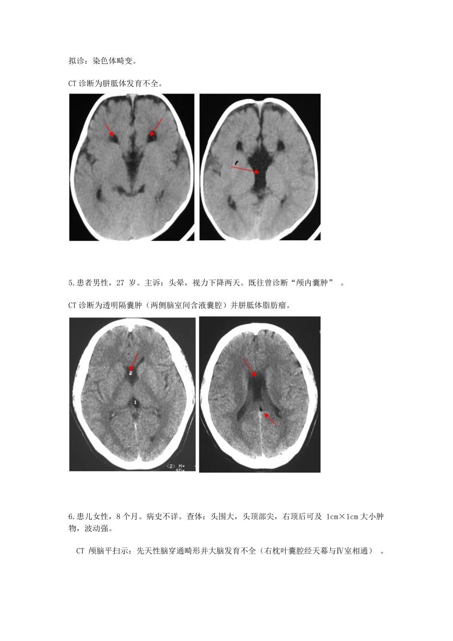 颅脑正常变异与先天异常ct图像(来源于ct临床诊断案例)_第3页