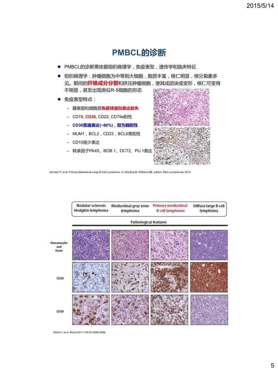 原发纵隔大b细胞淋巴瘤的诊断和治疗_第5页