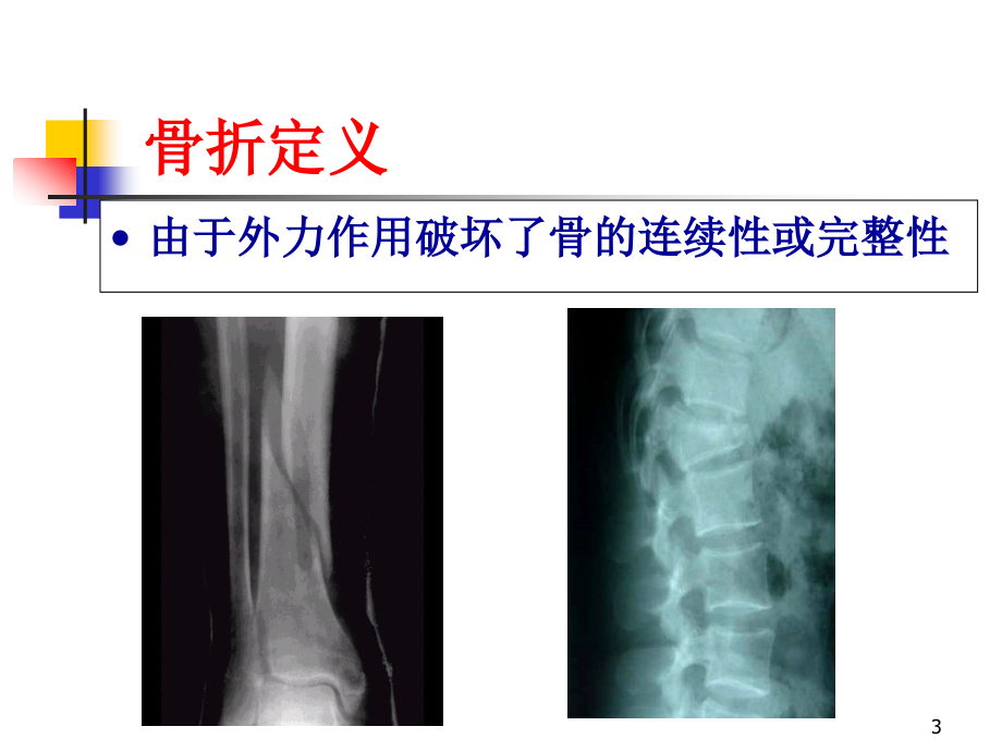 骨折概论_课件_第3页