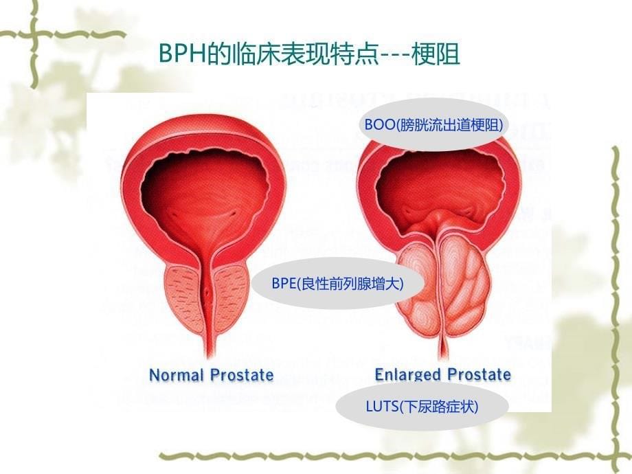 尿动力学检查在bph诊断中的应用43页_第5页