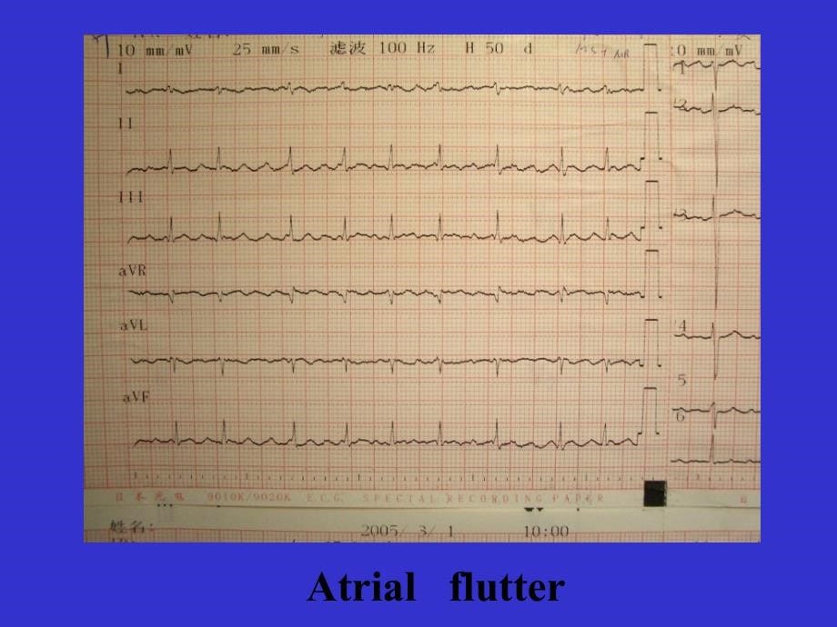 心律失常的急诊处理课件_第5页