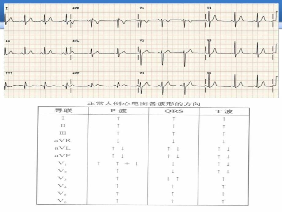 心电图基础知识及常见药物_第5页