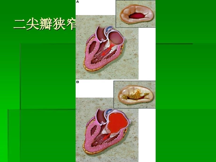 心脏杂音（cardiacmurmur）_第5页