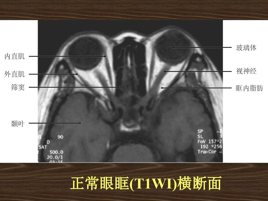 五官疾病mri诊断讲义_第5页