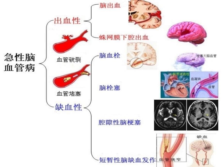 脑卒中的康复_第5页