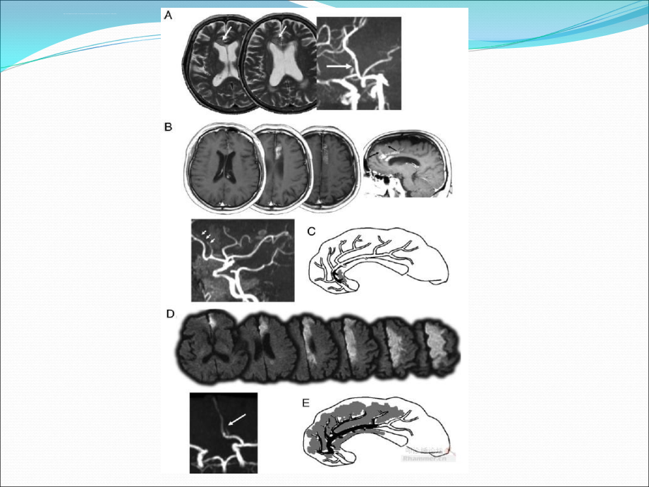 脑梗死责任血管分析课件_第4页