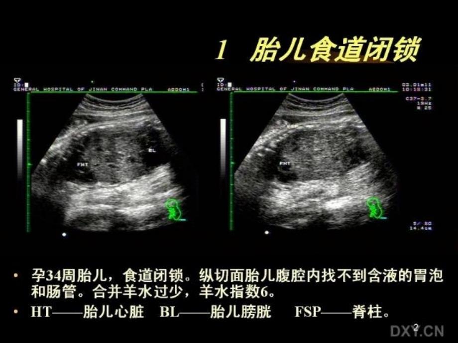 胎儿腹部畸形的超声诊断课件_第2页