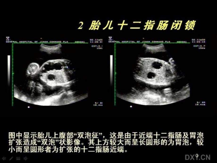 胎儿腹部畸形的超声诊断课件_第3页