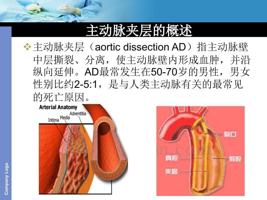 主动脉夹层护理查房课件_第5页