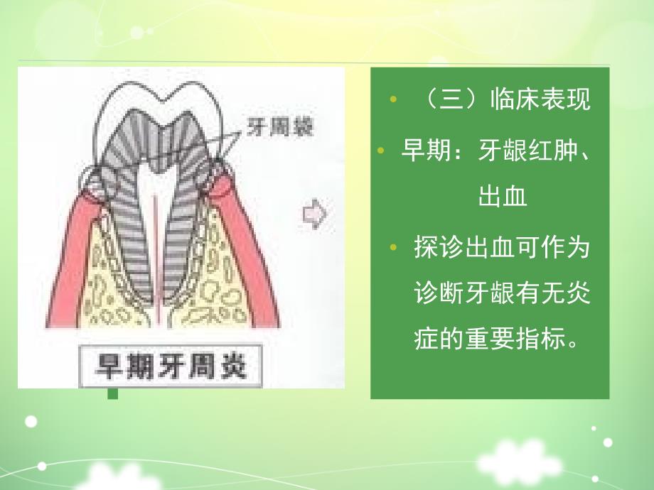 牙周炎病人的护理课件_第4页