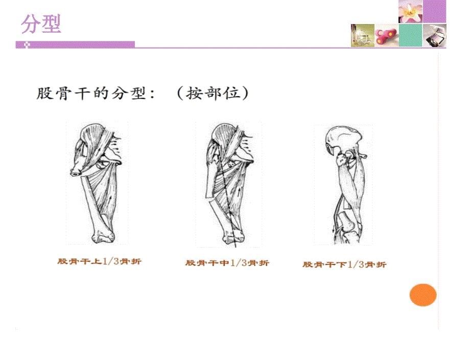 股骨干骨折护理课件_第5页