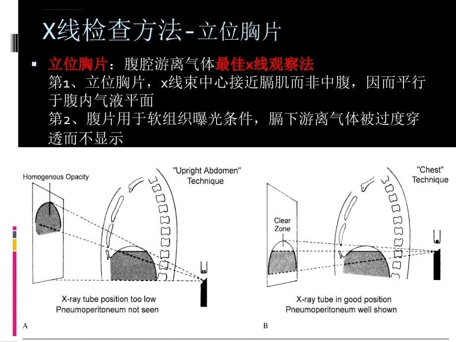 胃肠道穿孔课件_第5页