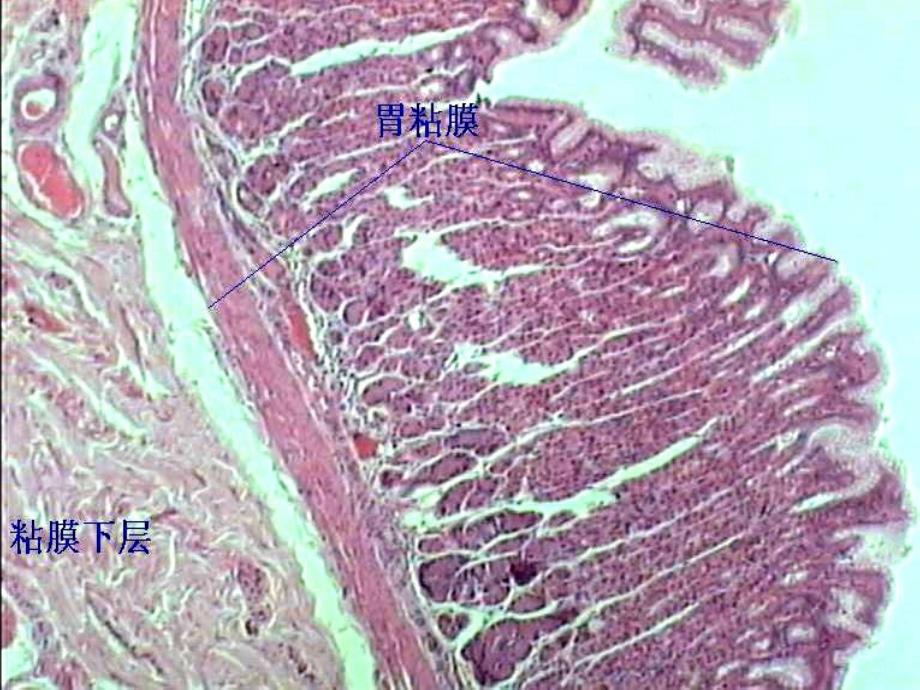 医学课件消化系统病理学_第4页