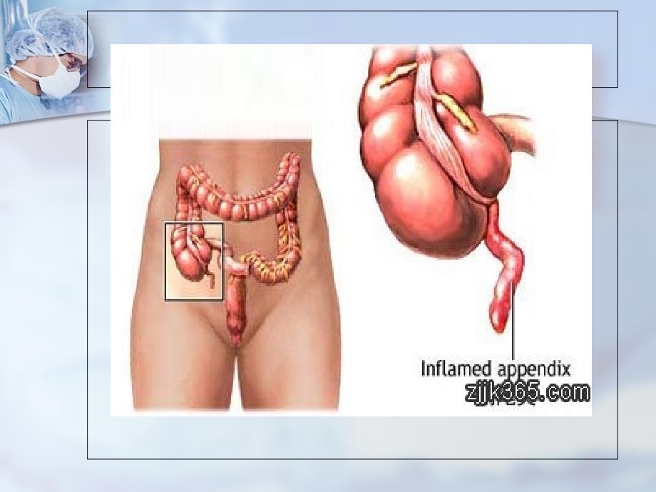 普外科护理业务查房急性阑尾炎课件_第3页