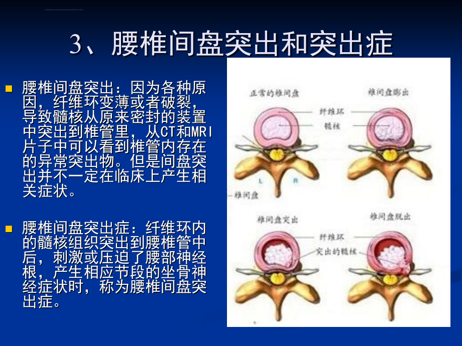 腰间盘突出症的康复治疗及相关问题课件_第4页