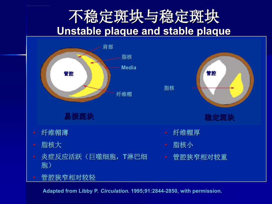 急性冠脉综合征课件_第3页